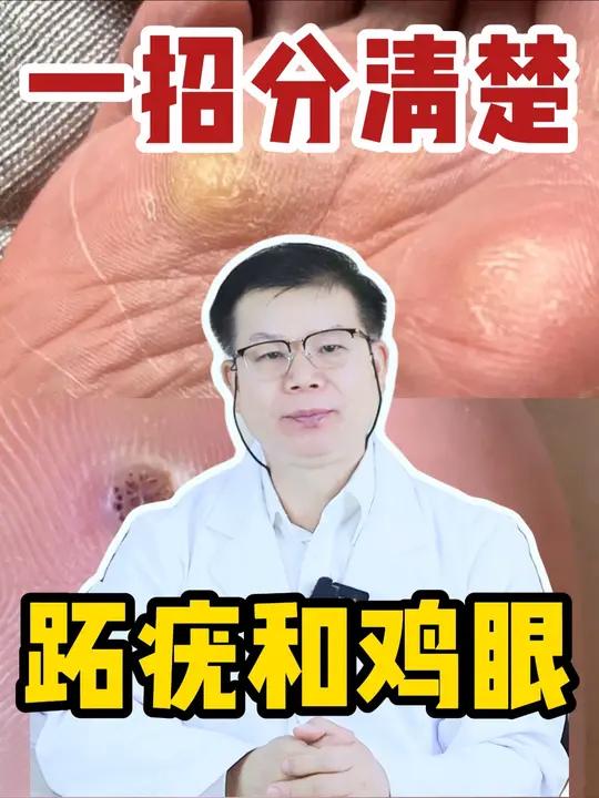 教你肉眼区分脚底的小疙瘩究竟是什么