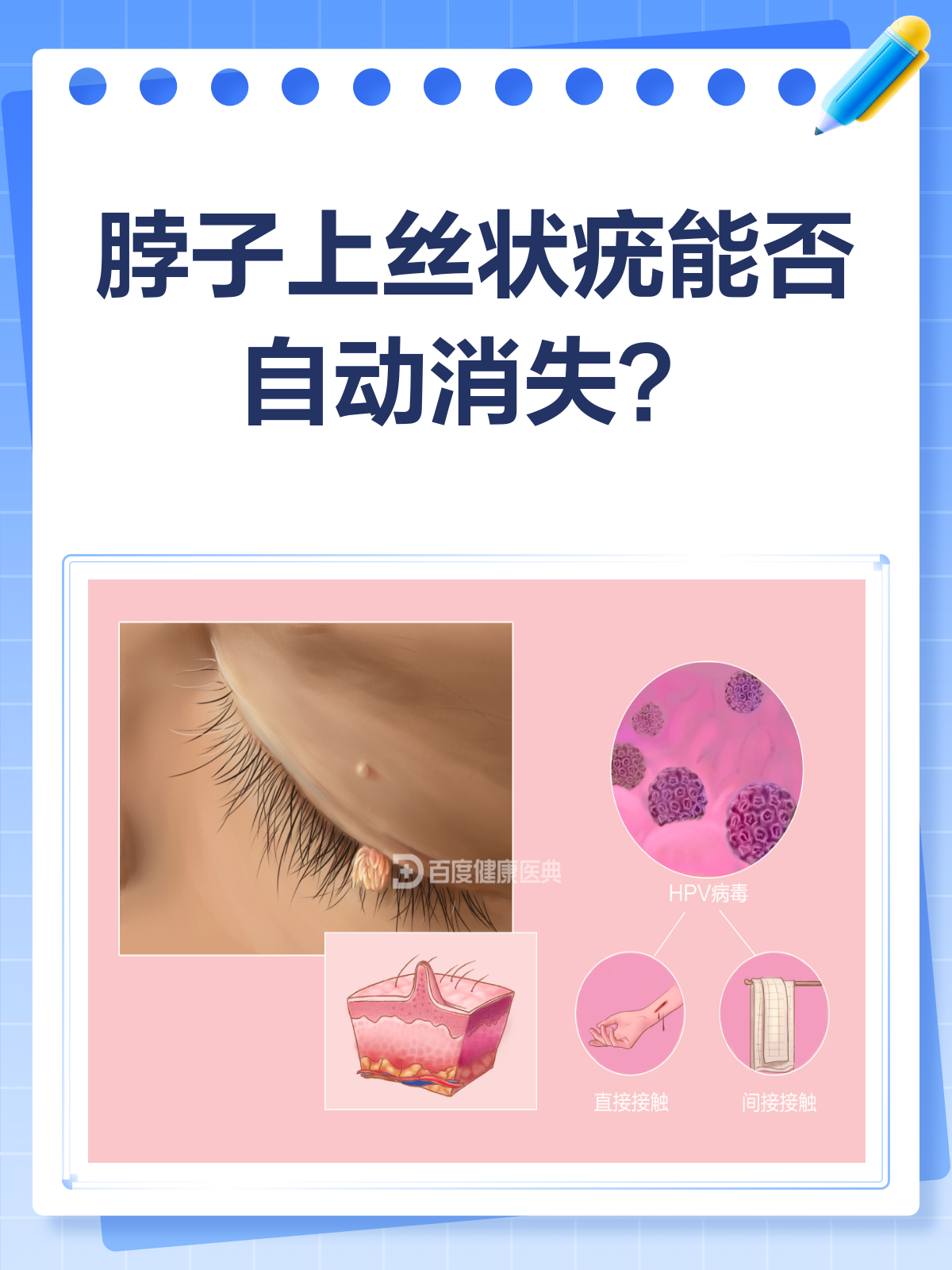 脖子上的丝状疣,时间久了会自动消失吗?
