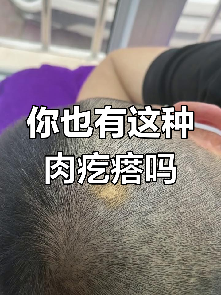 头皮上的小肉疙瘩,竟是皮脂腺痣