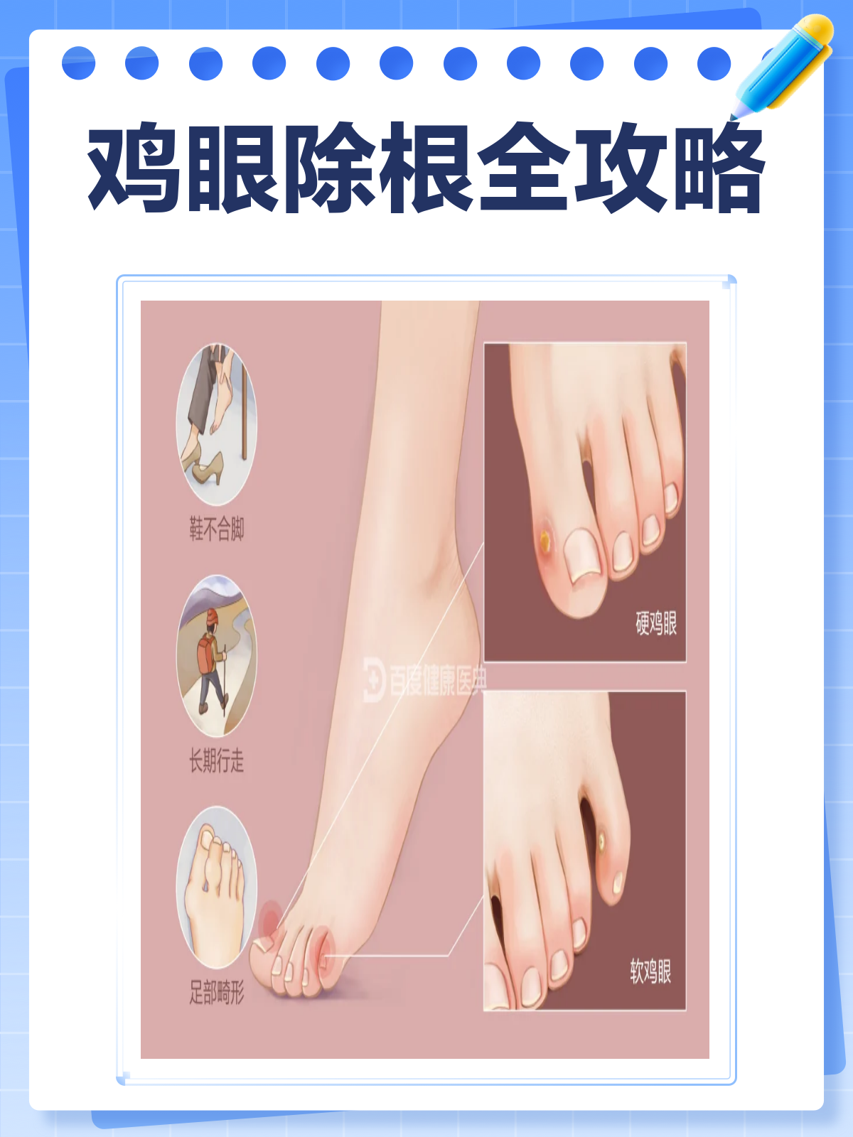 鸡眼怎么除根?这些方法值得一试!