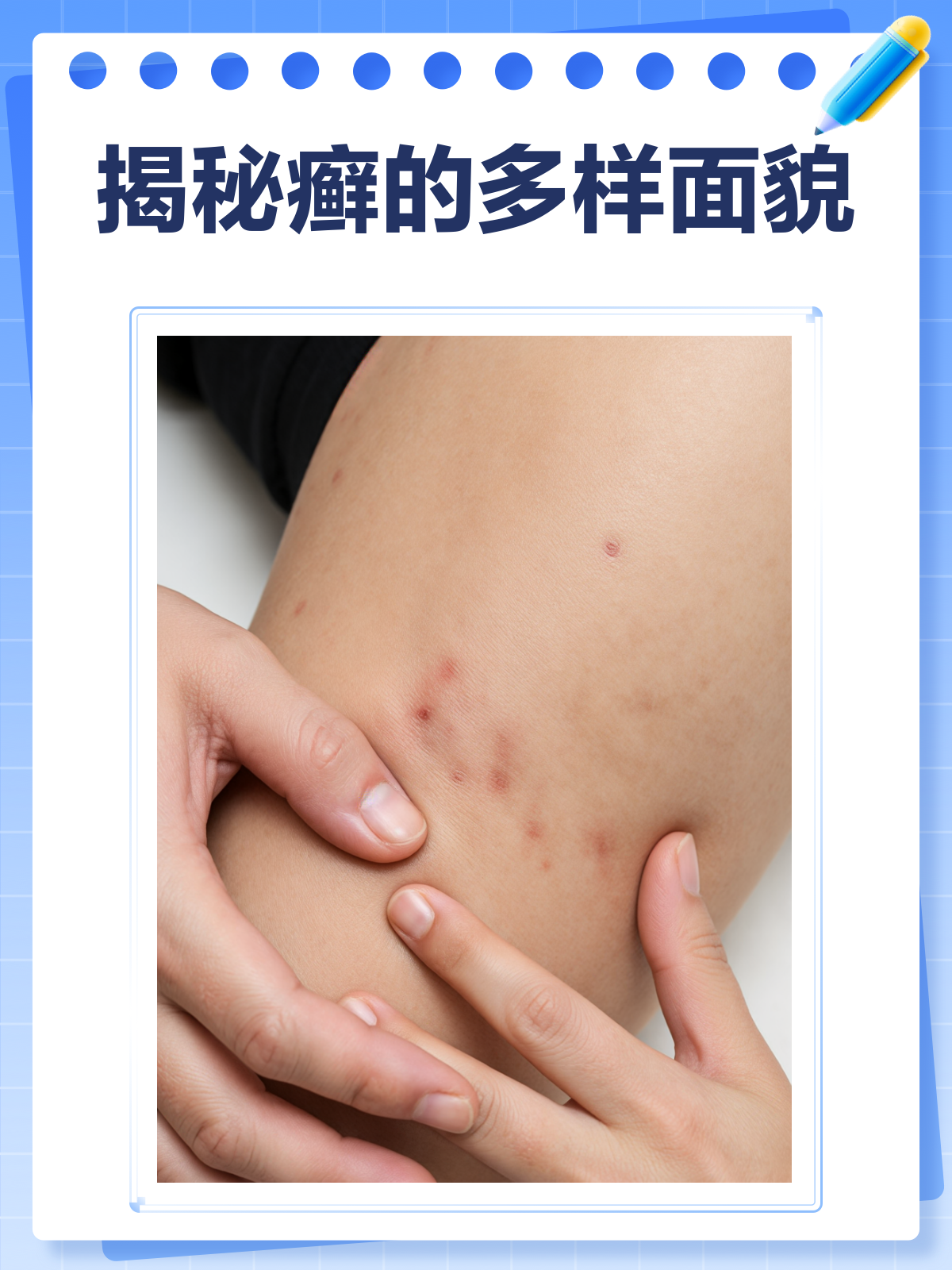揭秘癣的真面目！不同部位，样子大不同