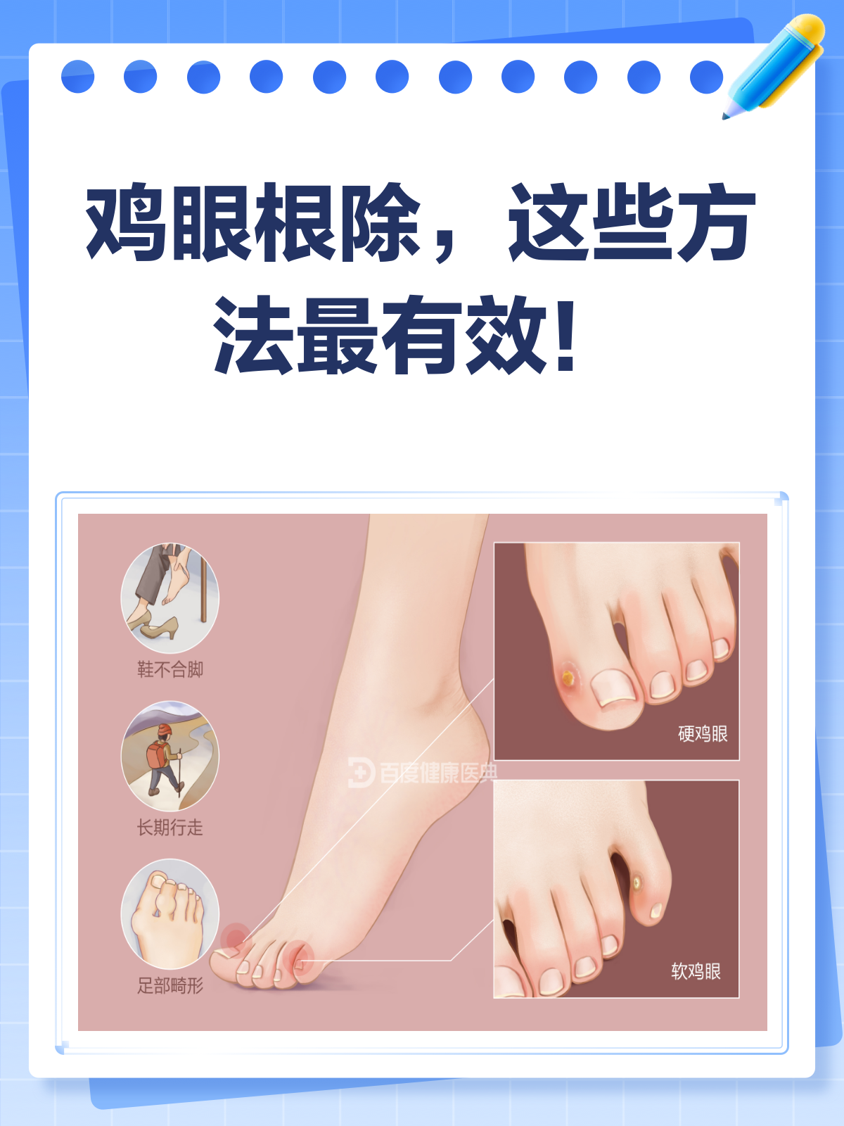 鸡眼烦恼别再有!根除方法大揭秘
