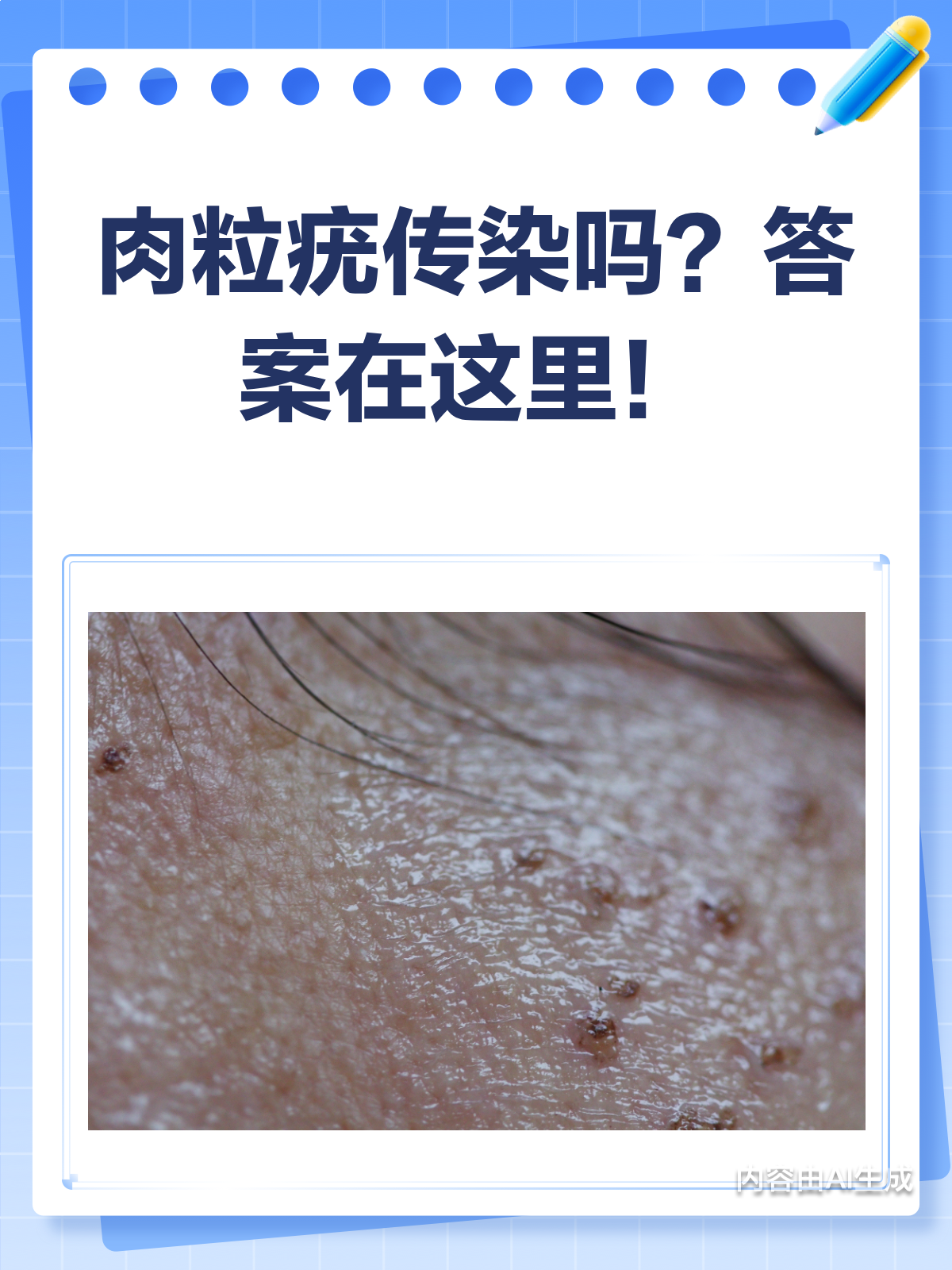 肉粒疣会传染吗?答案在这里!