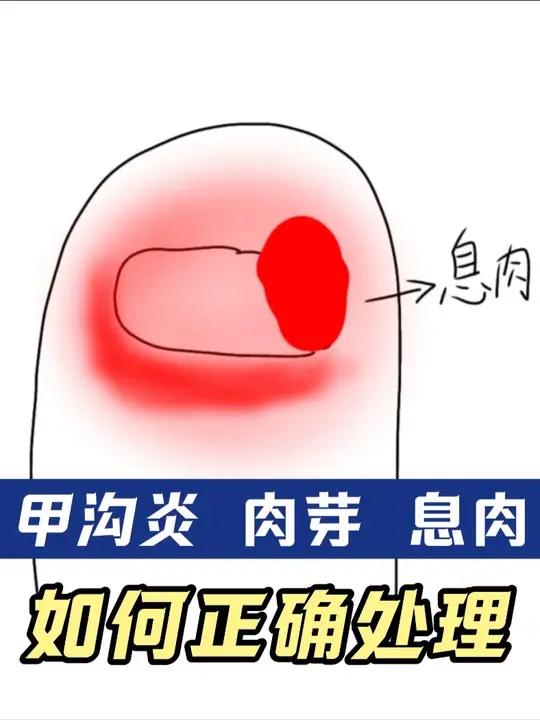 甲沟炎指甲长出肉芽｜息肉｜如何处理