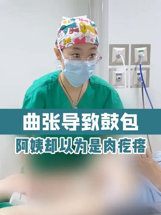 静脉曲张导致大腿长了一个鼓包,阿姨却以为是长了个肉疙瘩。