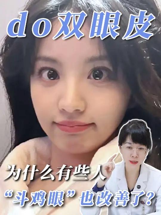 “斗鸡眼”还可以通过do双眼皮改善吗？科普 #上海九院王梓 #内斜视怎么矫正 #开眼角 #