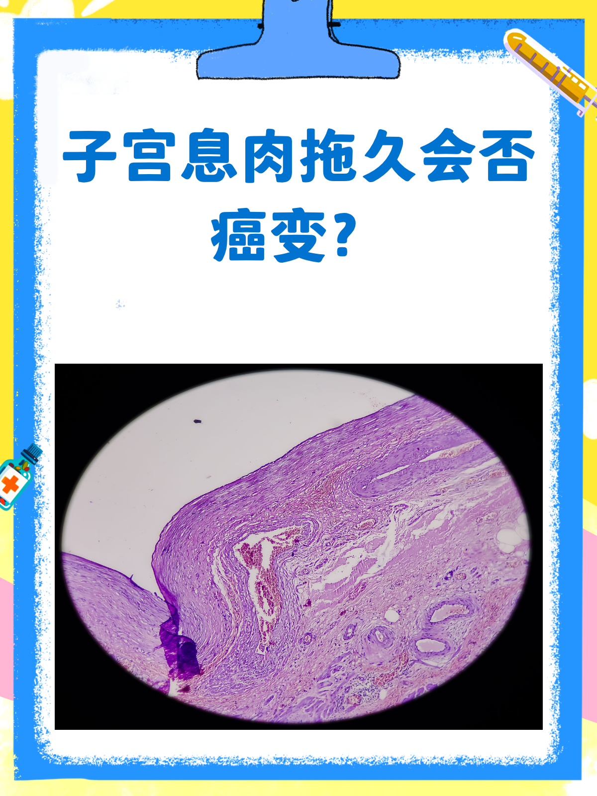 子宫息肉拖久了,真的会癌变吗?