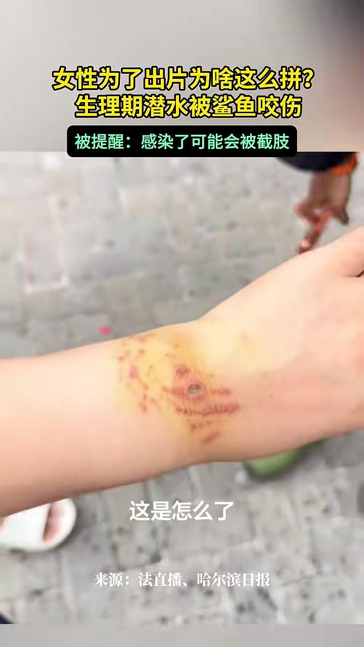女子为出片生理期潜水被鲨鱼咬伤,被提醒感染了会截肢 潜水 安全第一 鲨鱼来源:新闻晨报点击