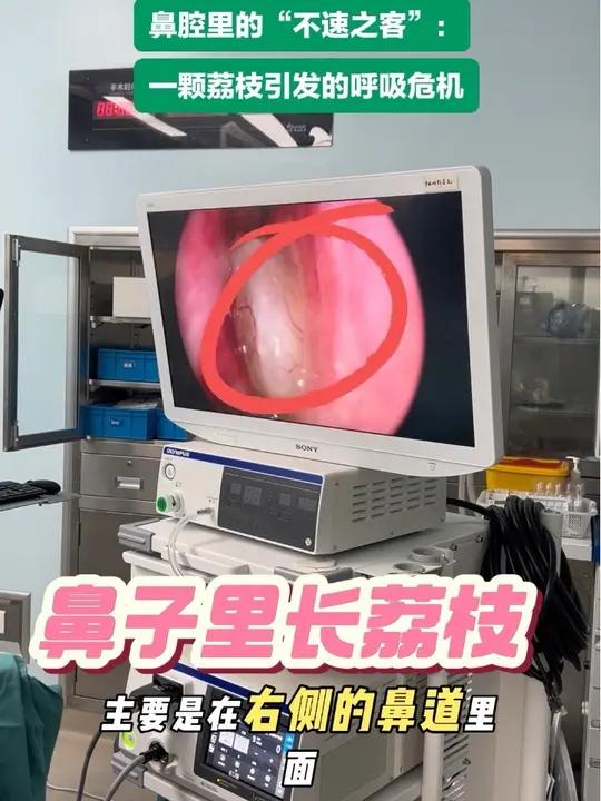 孩子鼻子里长了“小荔枝”?这不是玩笑!儿童鼻息肉全面揭秘,别把鼻息肉当荔枝!专家教您分辨孩