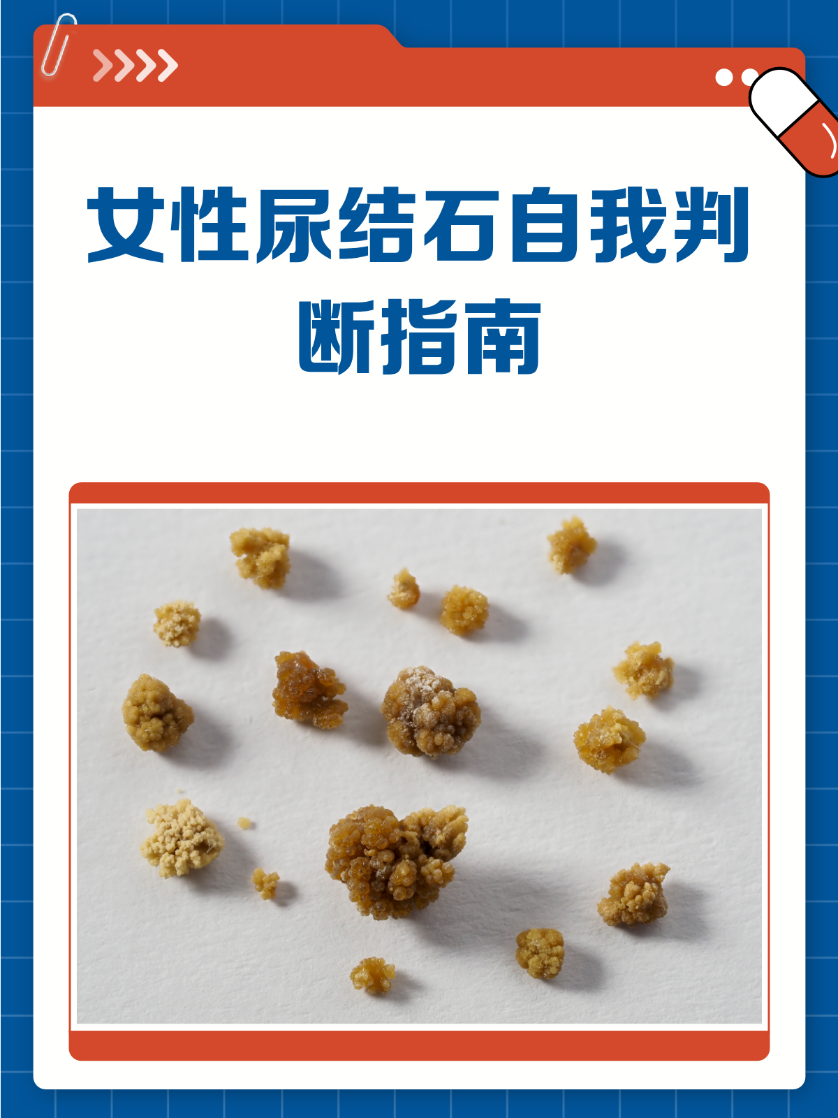 女性尿结石？这些信号别忽略！
