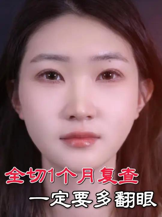 全切后别偷懒!翻眼练习防肉条、消肿胀 北京双眼皮 全切双眼皮