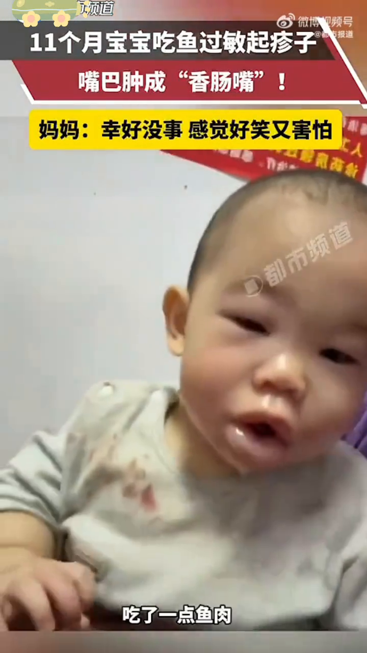 11个月婴儿吃鱼过敏肿成香肠嘴