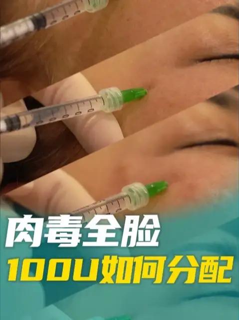 全脸肉毒100U如何分配 肉毒 除皱针