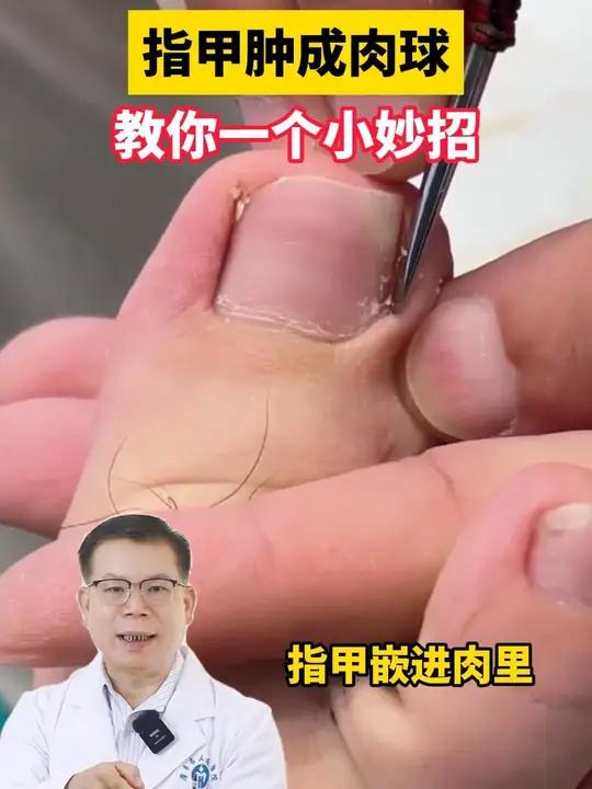 指甲肿成肉球,教你一个小妙招