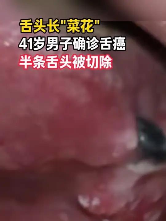深圳41岁男子刷牙时发现舌头长小疙瘩，误以为上火未重视，后肿块长成菜花状，确诊舌癌Ⅱ期
