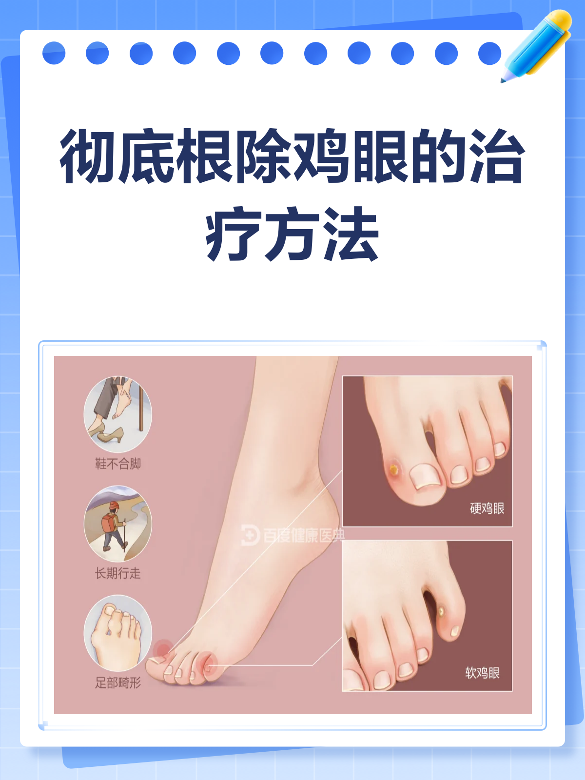 鸡眼烦恼别再有!彻底根除就看这一篇