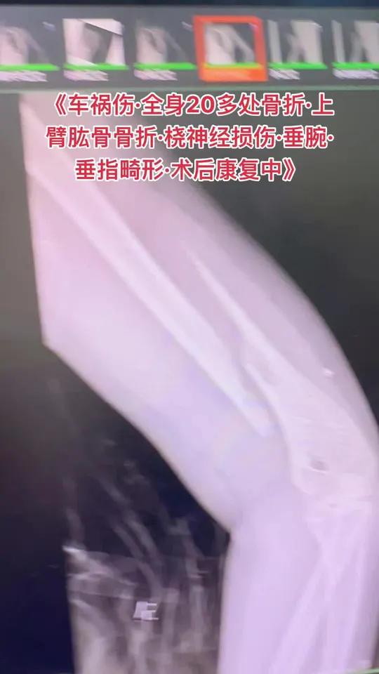 容易与肱骨骨折相伴随的桡神经损伤,需要加强功能锻炼和营养神经治疗
