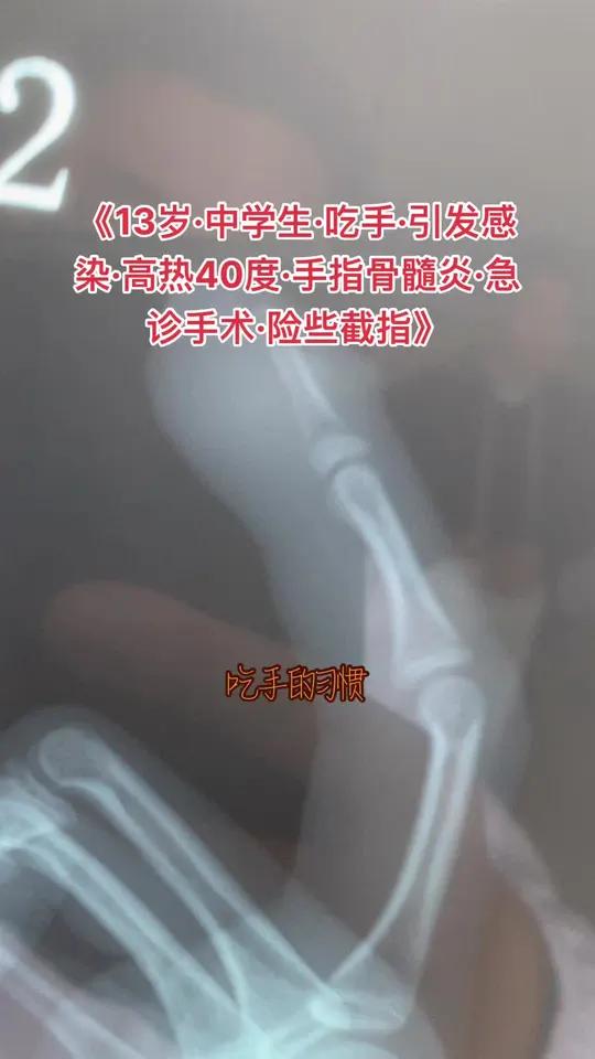 是一种心理习惯、但口腔细菌容易出现一系列严重的手指外观和感染问题、甚至骨髓炎截指啃指甲咬手