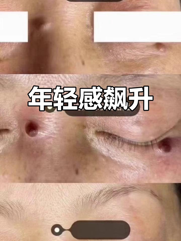 肉痣脱落后,颜值瞬间提升,感觉年轻了好几岁!