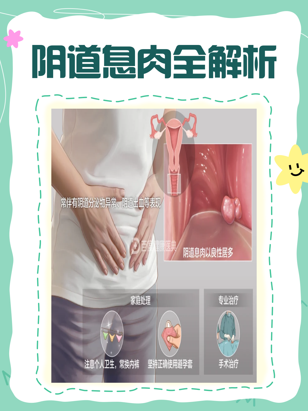 阴道息肉全解析,女性必看!