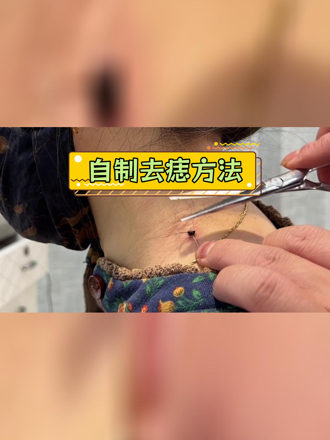 两天去除肉痣的小技巧