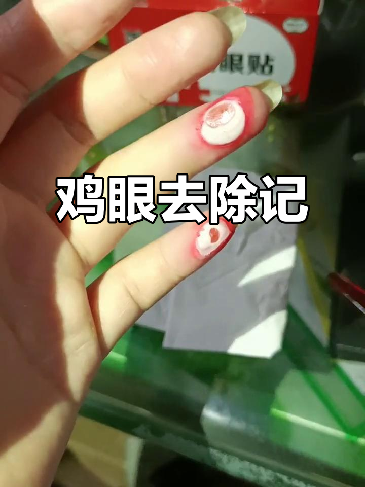 贴鸡眼膏，疼痛难忍！用刀割开才彻底清除