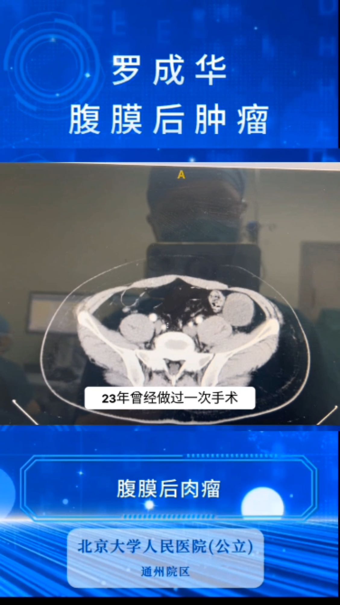 今天第二台手术,复发的腹膜后脂肪肉瘤也应做全腹膜后脂肪切除术