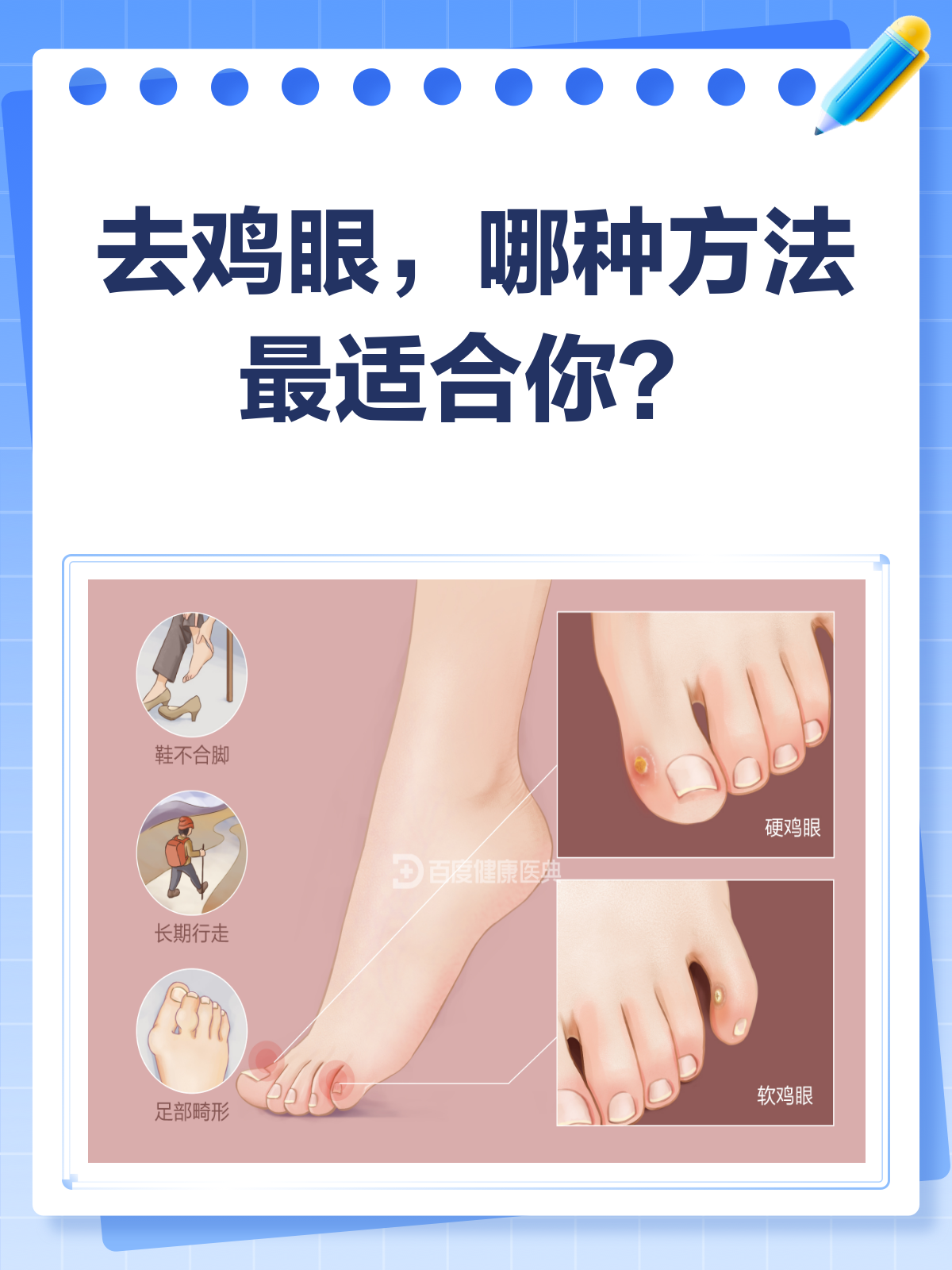 去鸡眼哪种方法最快?看医生怎么说