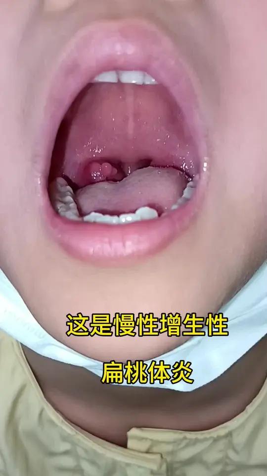 一年才可能遇到一例的病人,看着像乳头状瘤,实则是慢性增生!慢性增生性扁桃体炎,很多人不认识