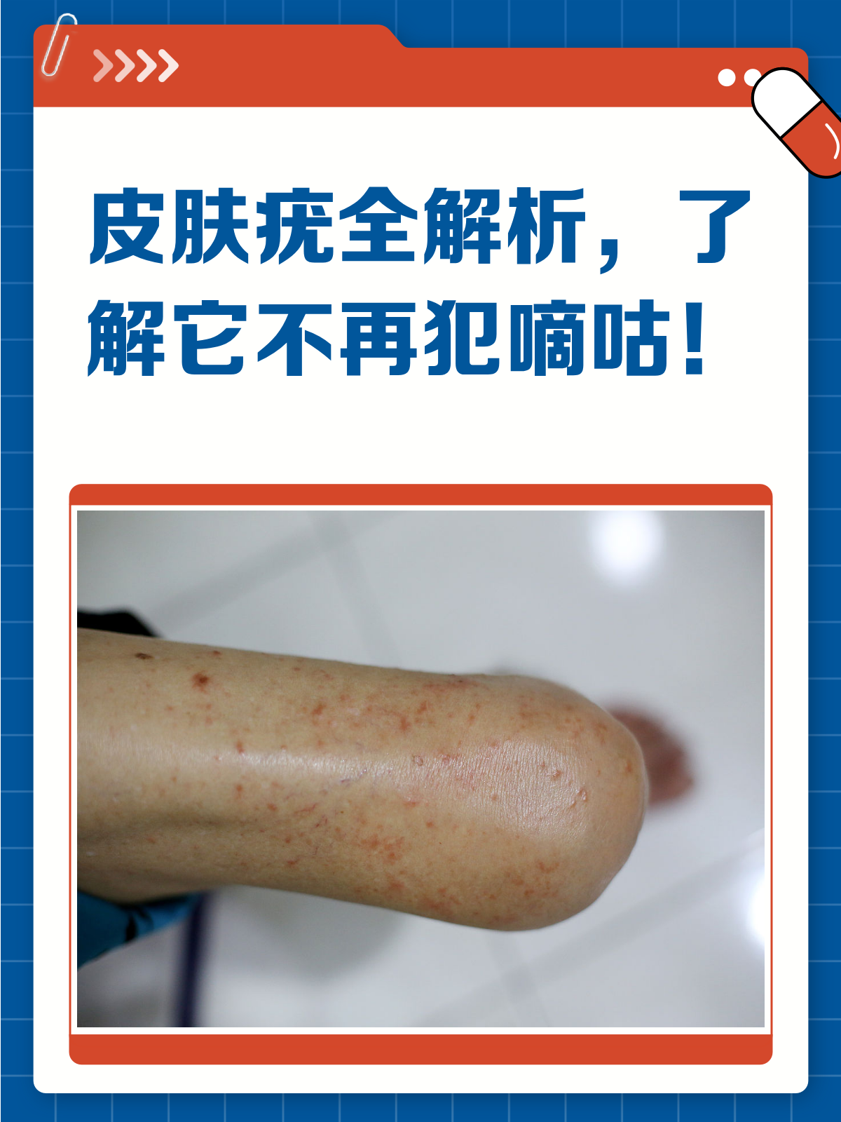 皮肤上的小肉揪是啥？一文读懂疣的那些事儿