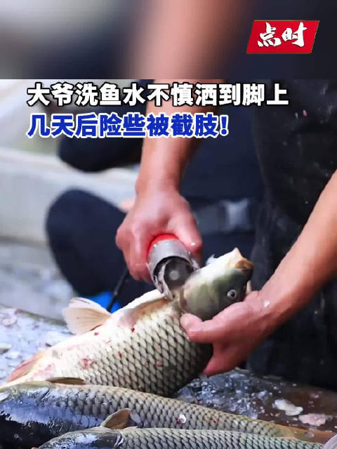 近日,浙江杭州,82岁的魏大爷(化名)清洗完黄鱼后,不小心将洗鱼水洒到了有伤口的左脚上。不