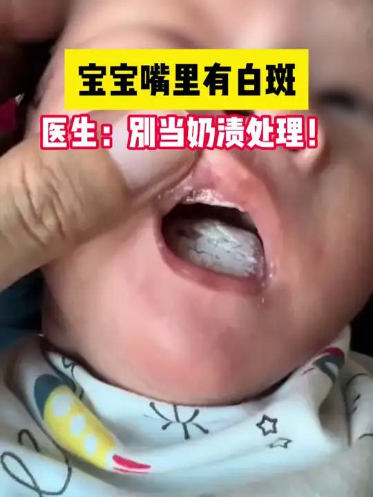 宝宝嘴里的“奶渍”清理不掉,可能是长了鹅口疮,试试这样处理!