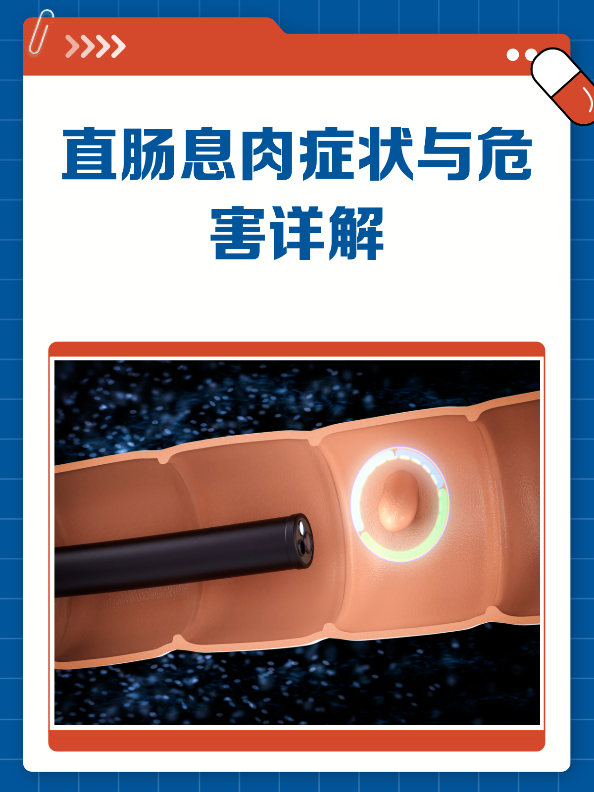 直肠息肉悄无声息?这些症状和危害你得知道!