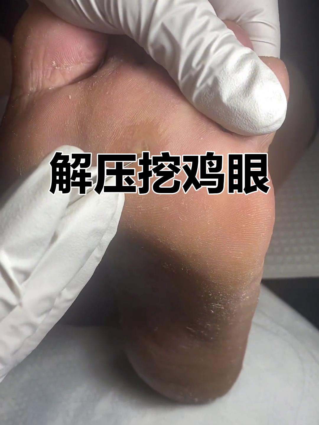 挖鸡眼解压,走路不再痛苦!