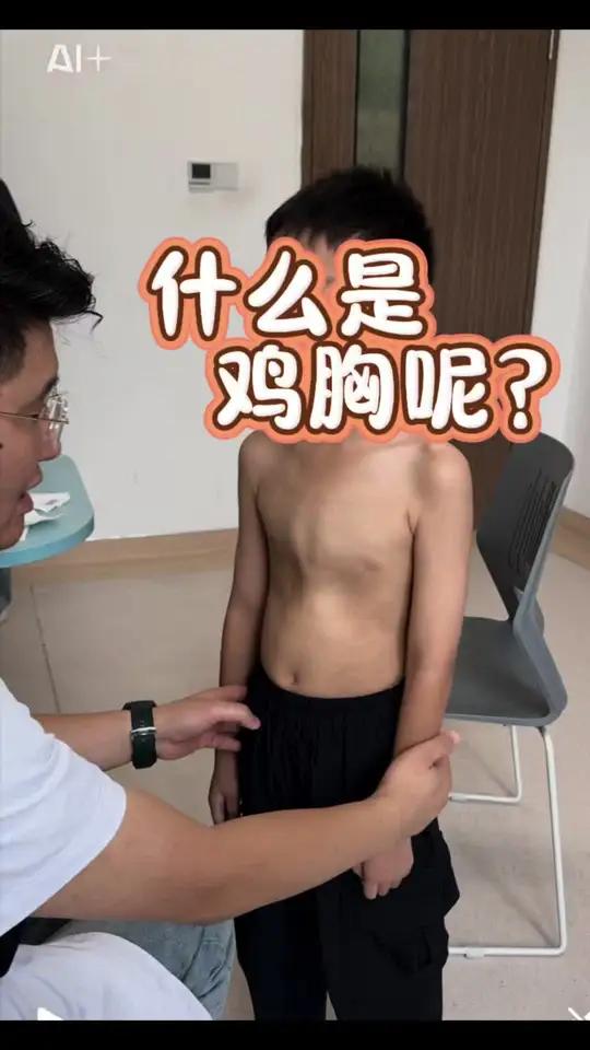什么样子的胸壁是鸡胸呢？