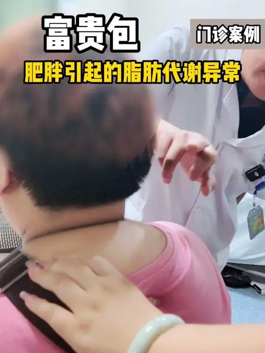 富贵包 大家可以看看自己脖子后面有没有凸起的大包,这个要注意了,可能是肥胖引起的代谢异常