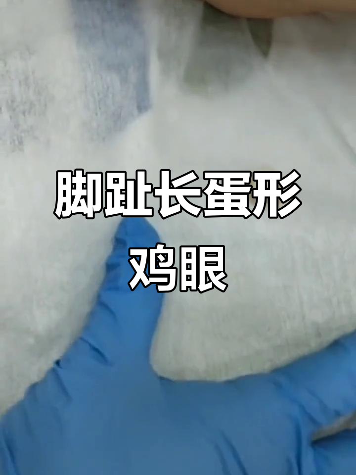 脚趾上的“鸡蛋”鸡眼,修脚师傅现场清理过程惊悚又解压
