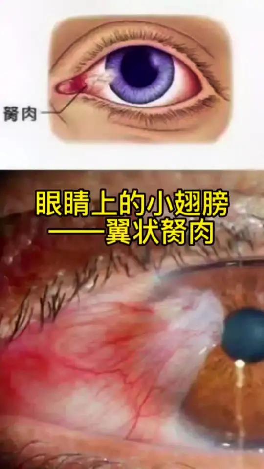 眼睛上的小翅膀——翼状胬肉