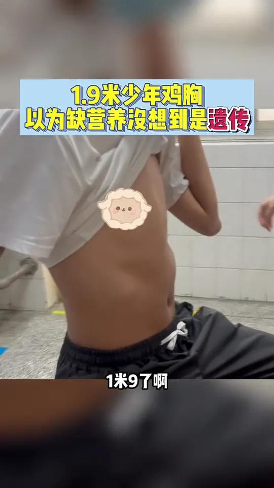 鸡胸和 漏斗胸都属于 胸廓畸形,患者大多都体型消瘦,因此很多人都以为是缺乏营养