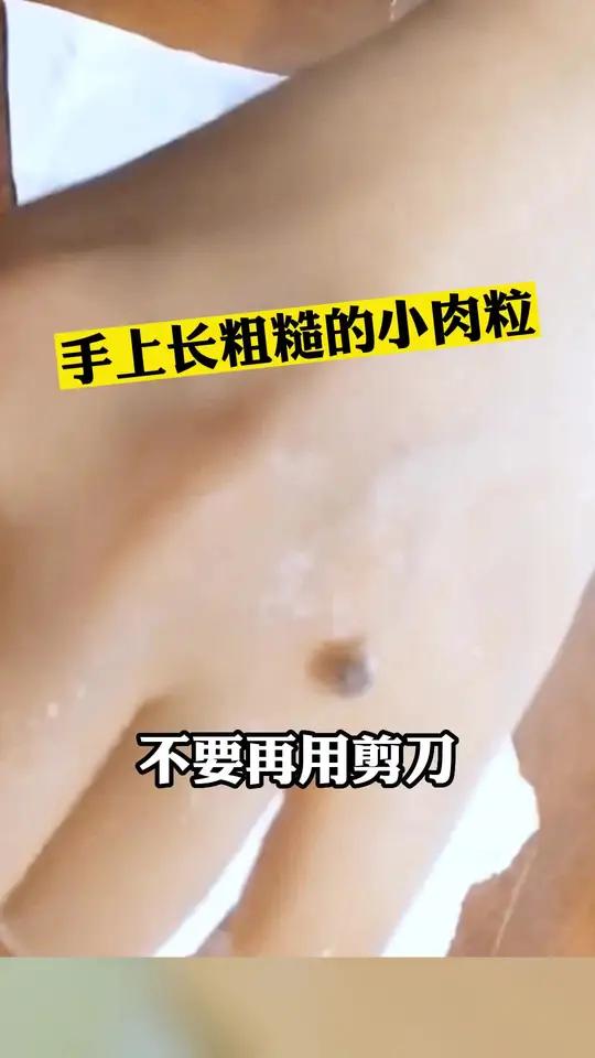 手上长寻常疣!怎么处理呢