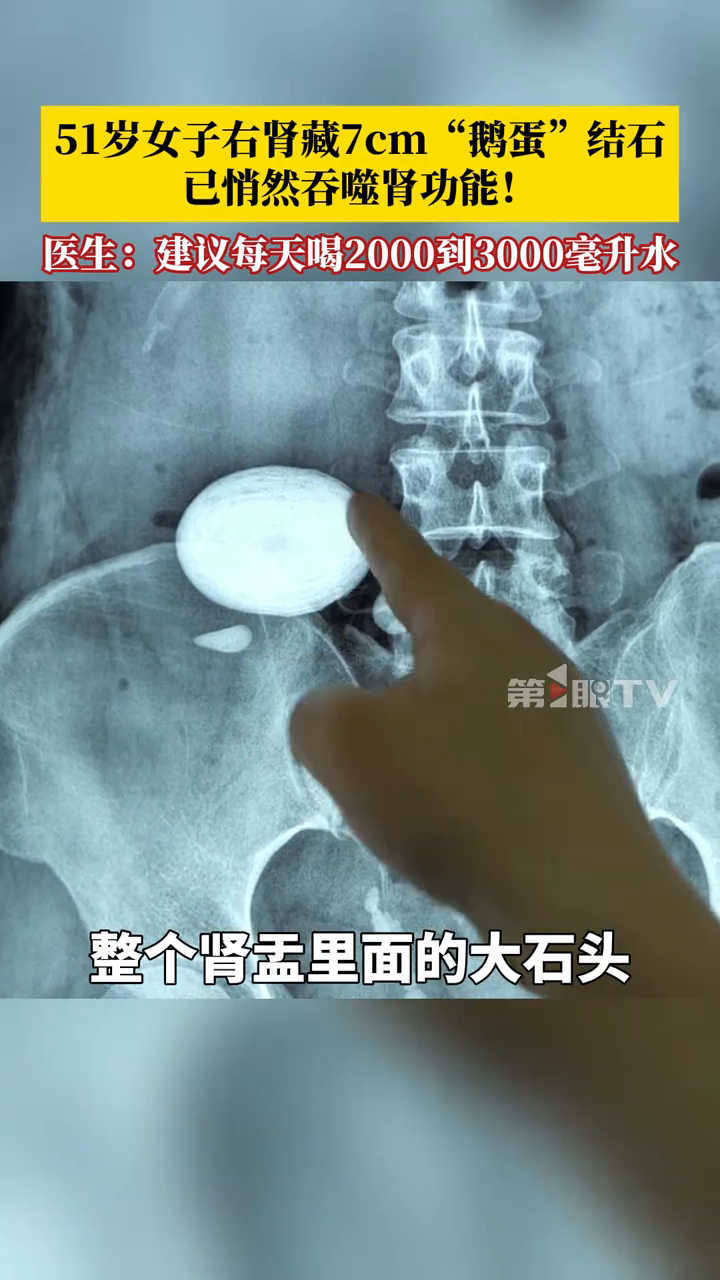 51岁女子右肾藏7cm“鹅蛋”结石,医生:建议多喝水