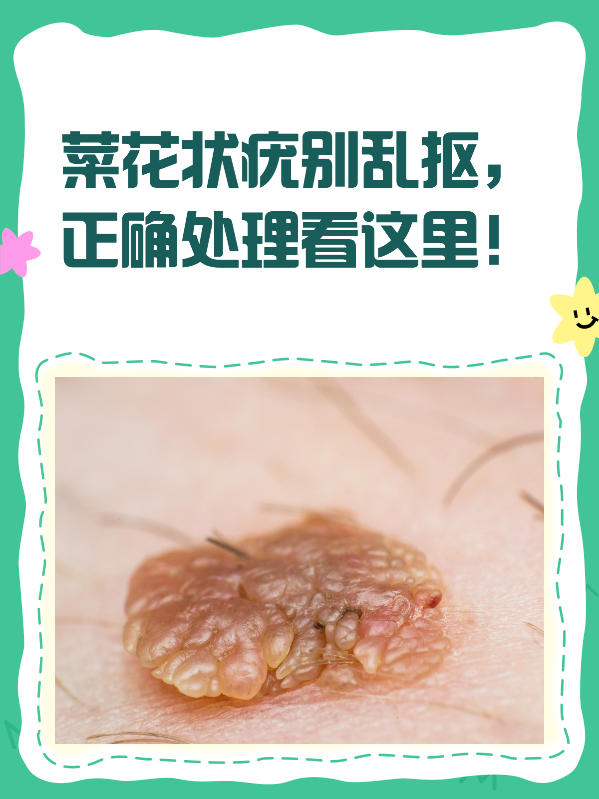 菜花状疣自己抠掉就万事大吉了？千万别这么做！