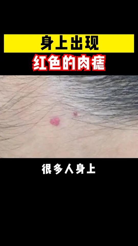 身上出现红色肉痣是怎么回事