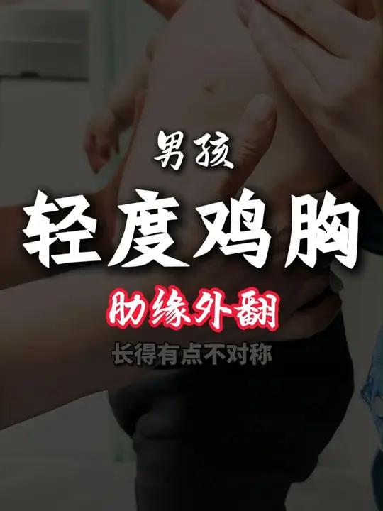 男孩轻度鸡胸加肋缘外翻,但家长不用过度焦虑,孩子现在还小,胸肋骨还有弹性,是可以矫正的