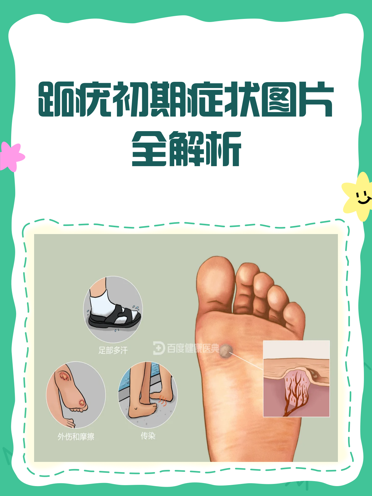 跖疣初期长啥样?一文带你认清它