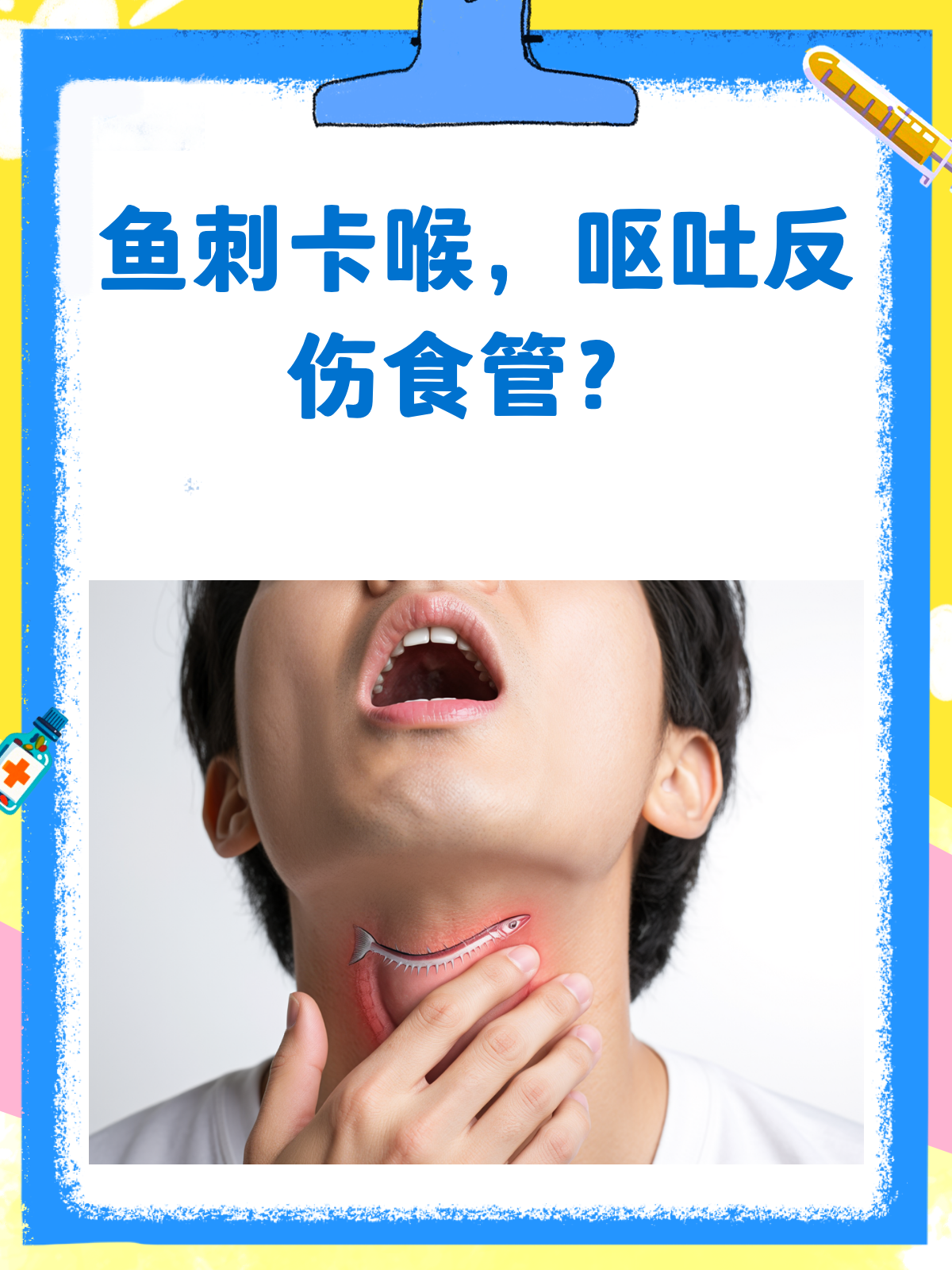 鱼刺卡喉别乱吐!小心损伤食管