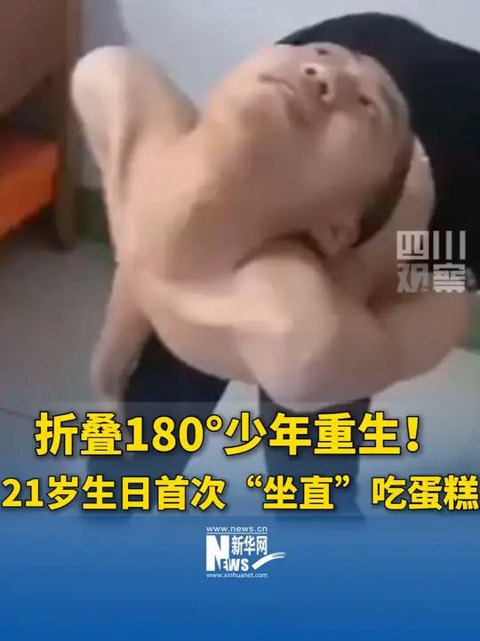 折叠180°少年重生！21岁生日首次“坐直”吃蛋糕，医生祝福暖哭网友