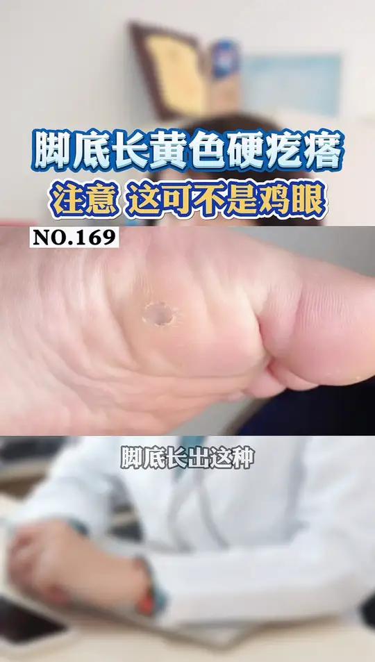 经常走路,脚受到挤压就容易长硬疙瘩,但可能不是鸡眼,要注意是不是hpv引起的