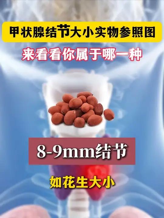 甲状腺结节大小实物参照图,看看你属于哪一种 #抖出健康知识宝藏 #龚勇医生 #甲状腺结节 