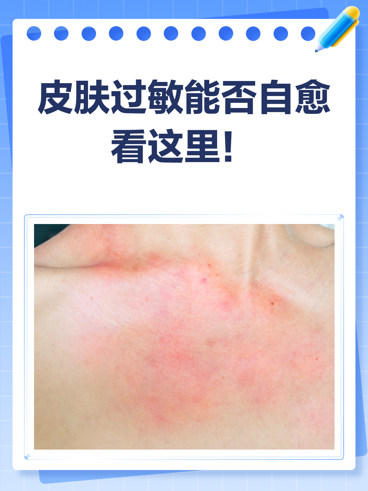 皮肤过敏,真的能自愈吗?